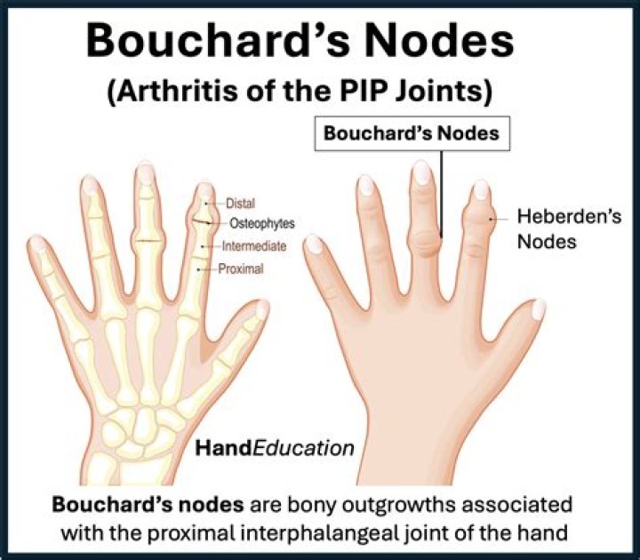 Can heberden’s nodes disappear?