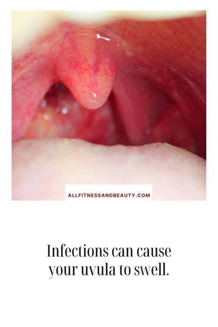 Can snoring cause a swollen uvula?