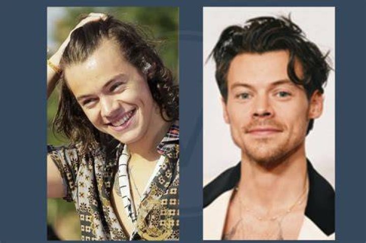 Did Harry Styles have braces?