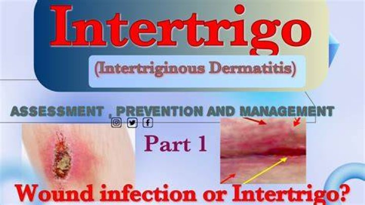 How do I treat intertrigo?