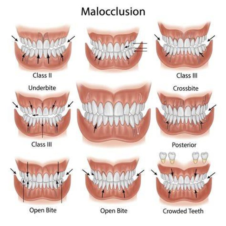 How do you align ClustalW?