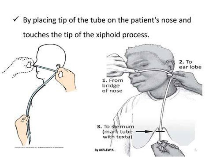 How do you check NG tube placement ATI?
