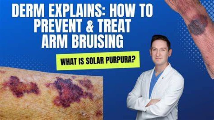 How do you get rid of bruises from donating plasma?