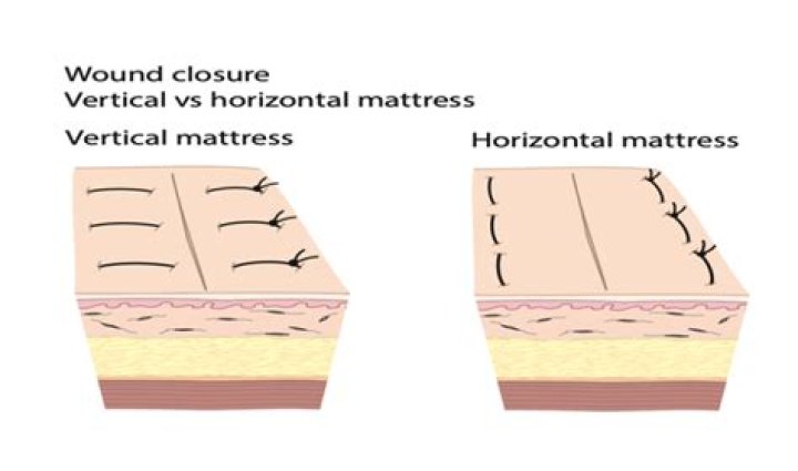 How do you suture a horizontal mattress?