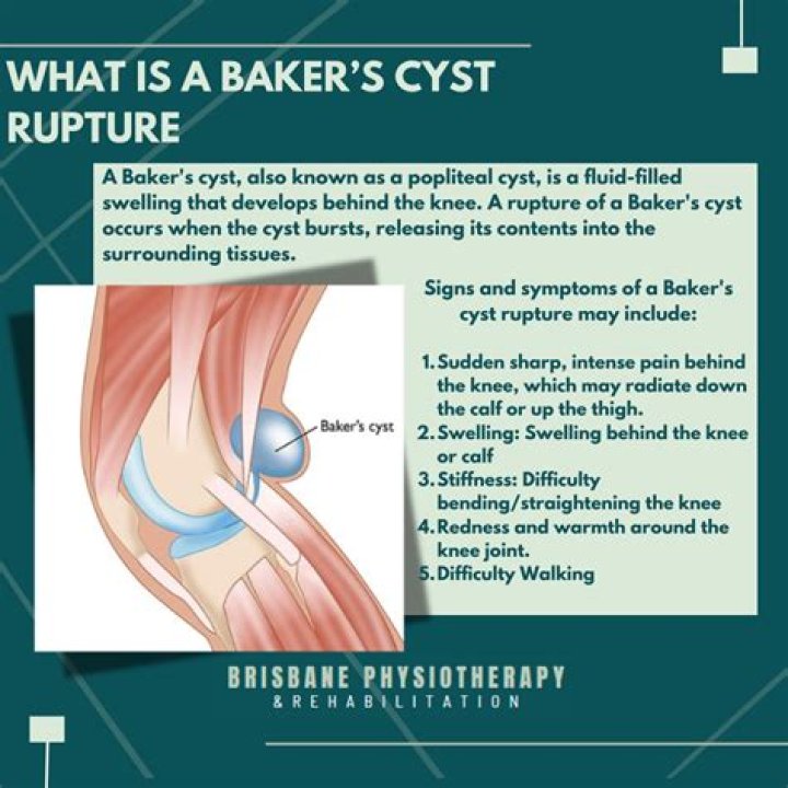How do you treat a Baker’s cyst?