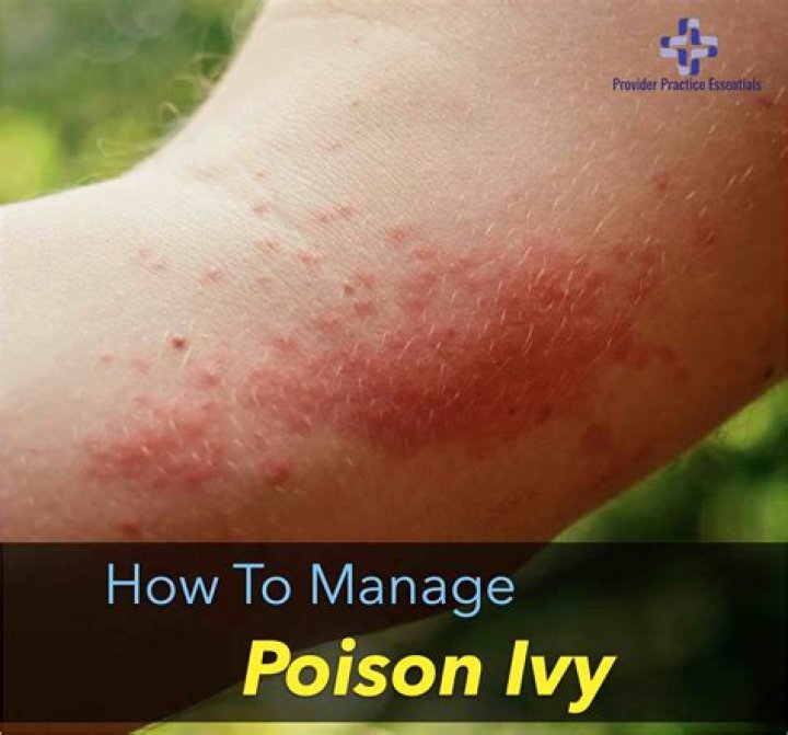 How long after steroid shot does poison ivy go away?