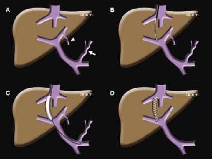 How long can you live after a TIPS procedure?