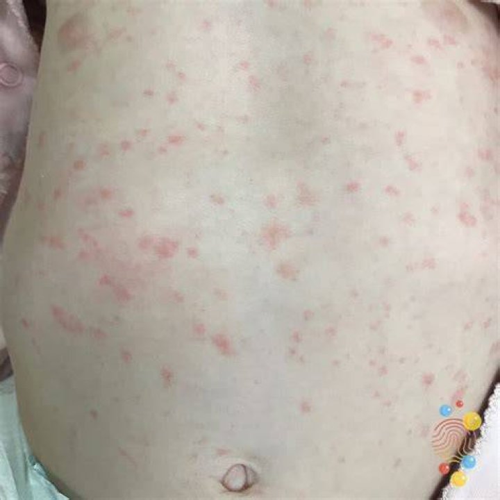 How long does a roseola rash last?