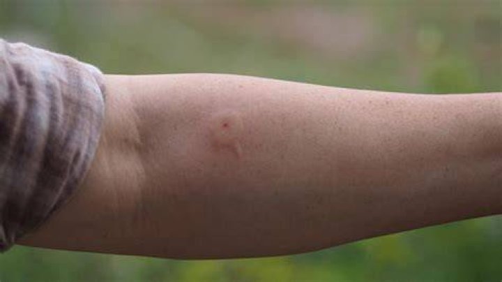 How long does an ASP sting hurt?