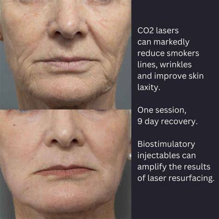 How much does a Cutera laser cost?