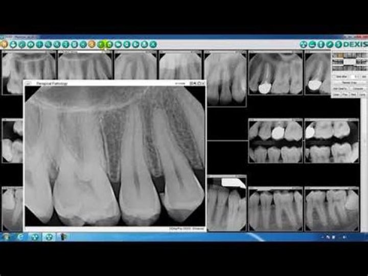 how to delete x rays on dexis?