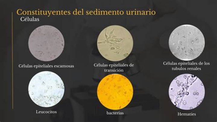 ¿Qué significa células epiteliales en la orina?