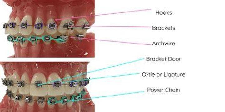 What are braces ligatures?