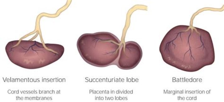 What causes double lobed placenta?