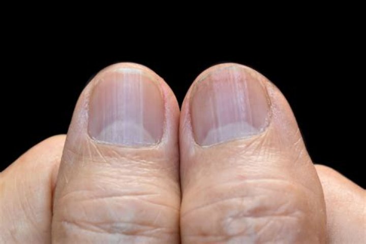 What causes red streaks in fingernails?
