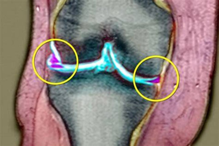 What does a blown out knee feel like?