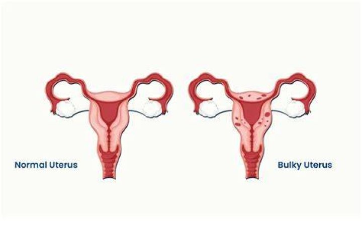 What does a boggy uterus mean?