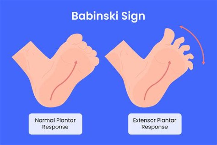 What does a positive Babinski sign mean?
