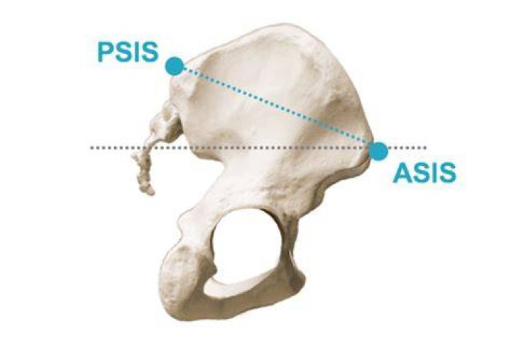 What does Asis mean in medical terms?
