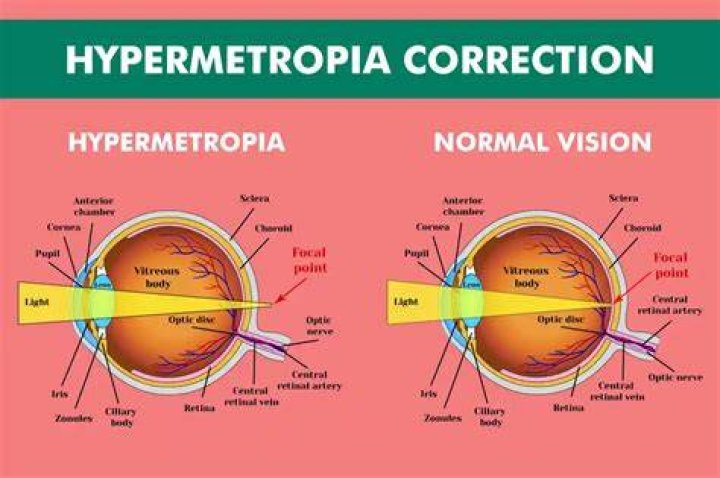 What does Hypermetropia bilateral mean?