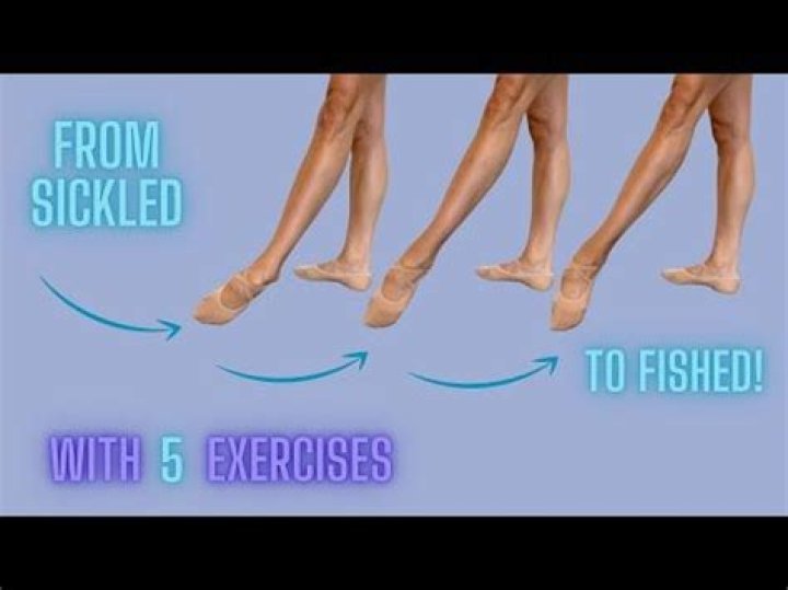 What does it mean to have sickled feet?