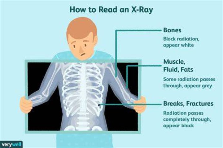What does X ray mean on prime?