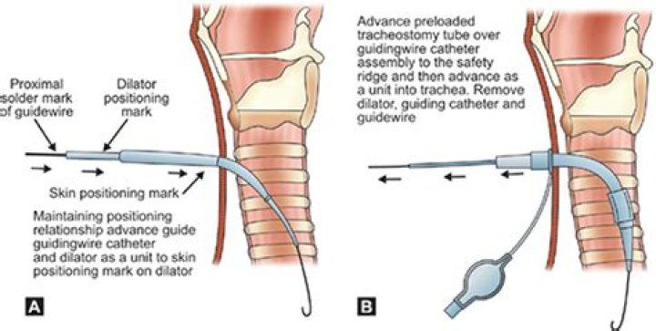 What is a percutaneous tracheostomy?