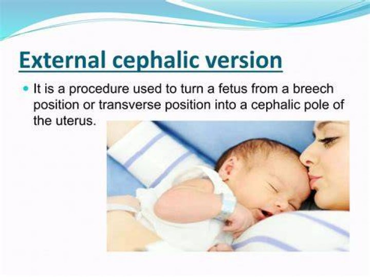 What is internal cephalic version?