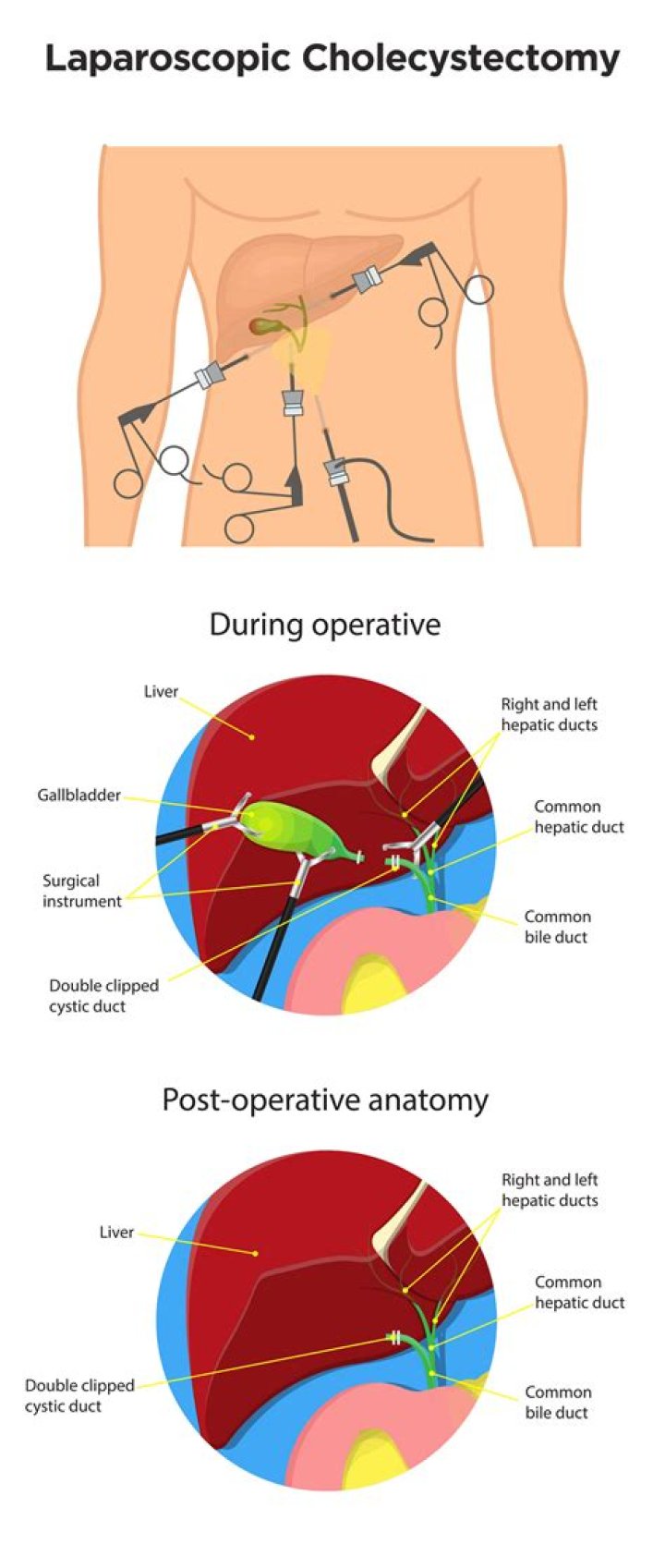 What is lap coli procedure?