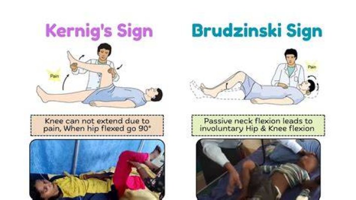 What is the Brudzinski’s sign?