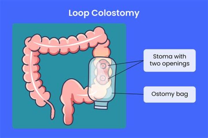 What is the CPT code for colostomy reversal?
