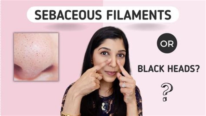 When i squeeze my nose pores white stuff comes out 2?