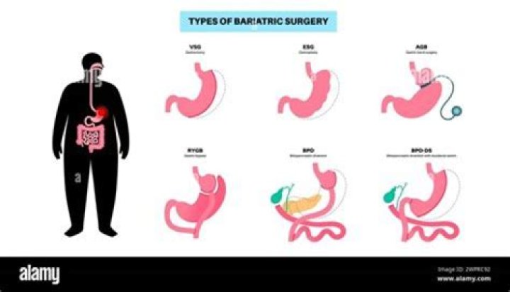 Which surgical procedure treats morbid obesity by decreasing the stomach to a small pouch and shortening the jejunum?