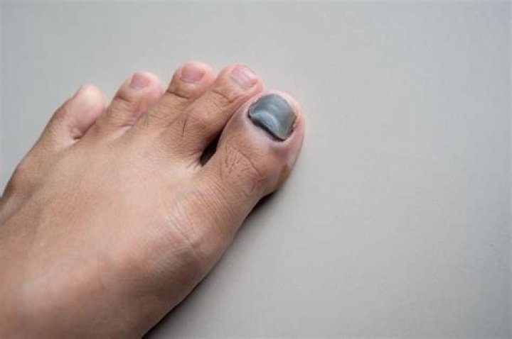 Why are my toes turning dark?