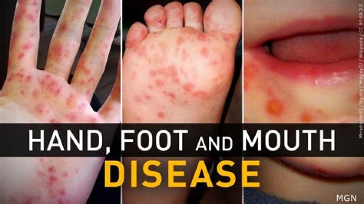 Why do I keep getting hand foot and mouth disease?