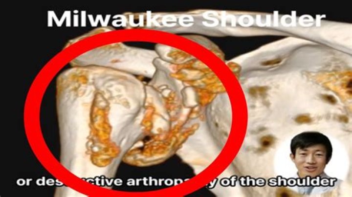 Why is it called Milwaukee shoulder syndrome?