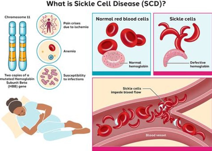 Why is sickle cell anemia codominant?
